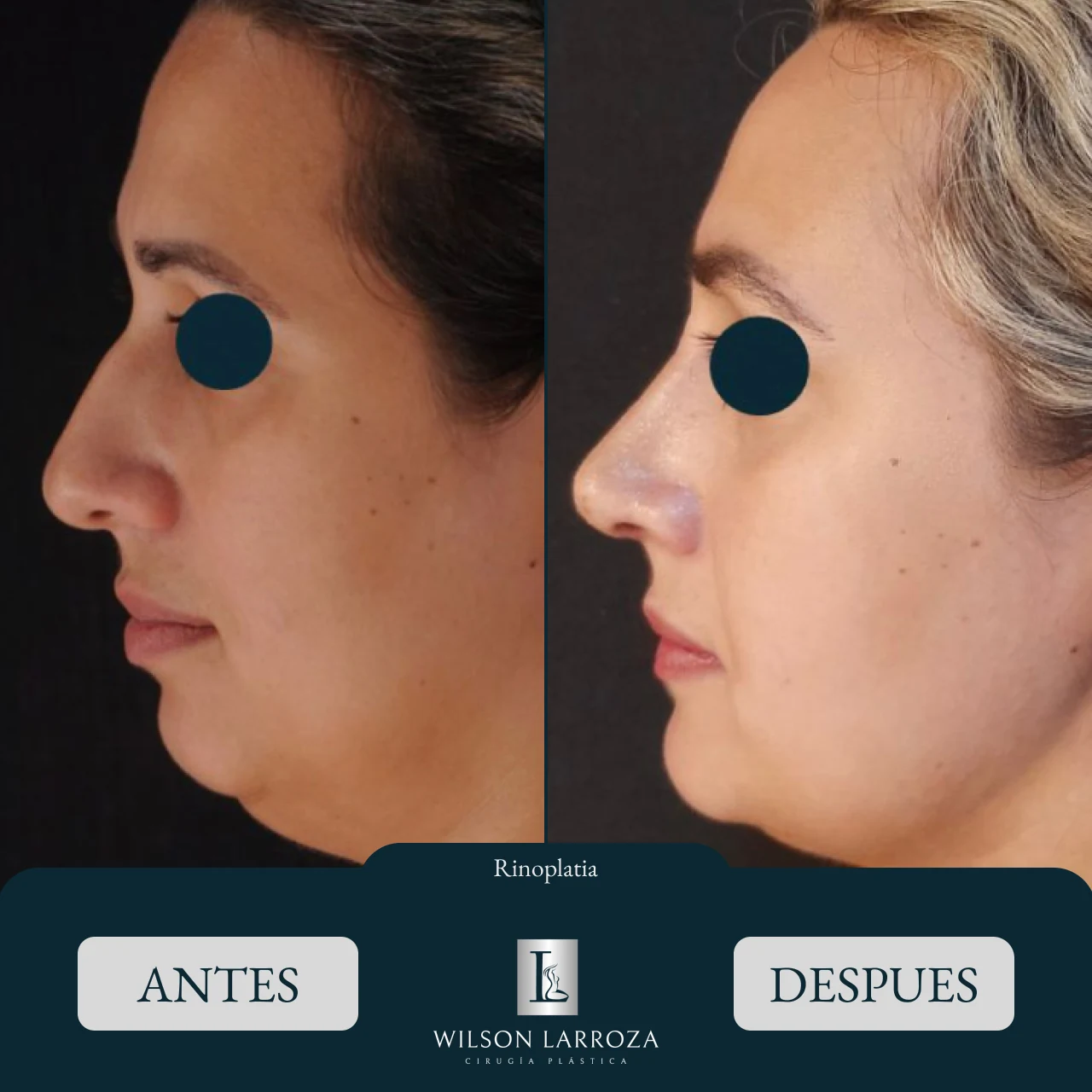 Resultado 4 | Cirujano Plástico en Paraguay Asunción
