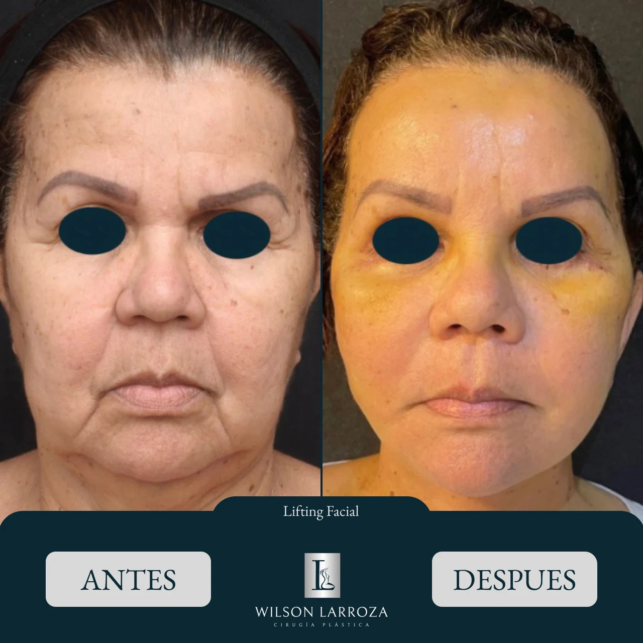 Resultado 6 | Cirujano Plástico en Paraguay Asunción