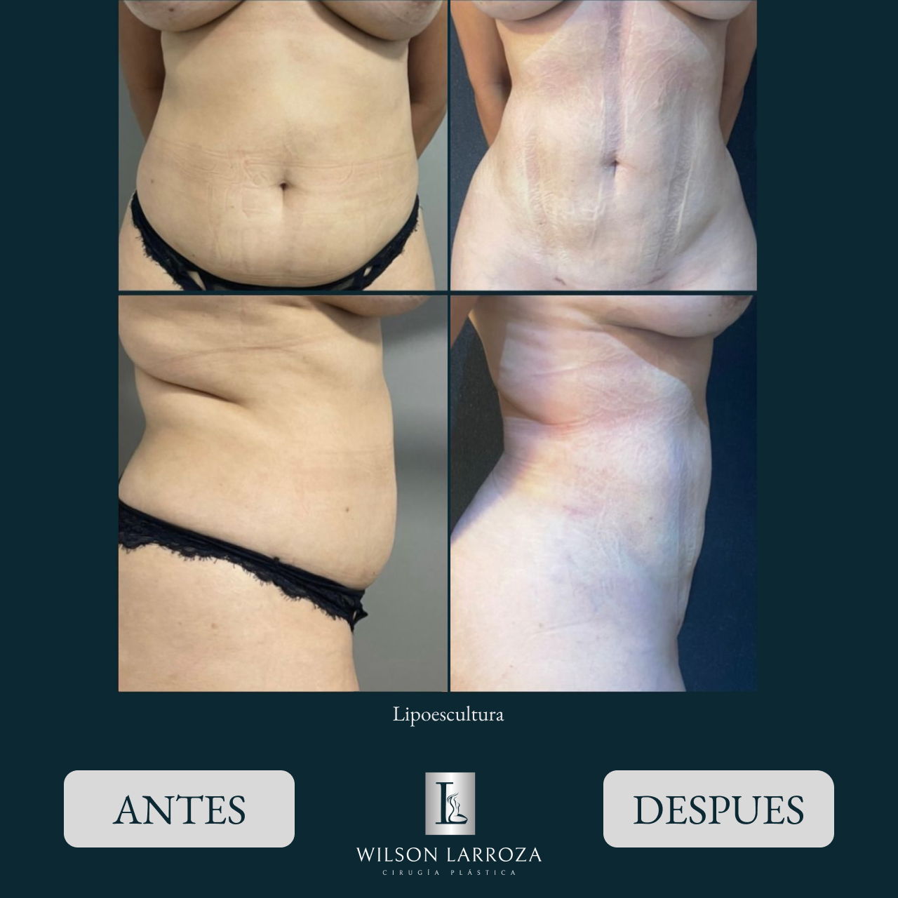 Rinoplastia en Asunción Paraguay