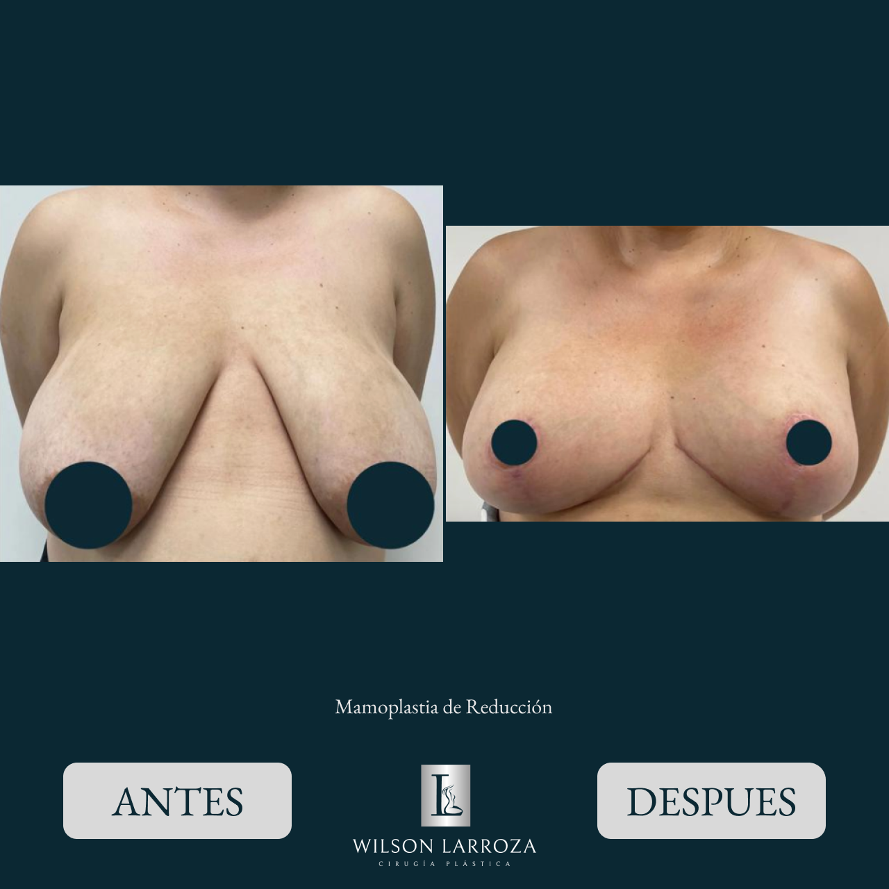 Resultado de una Reducción Mamaria en Asunción Paraguay.png