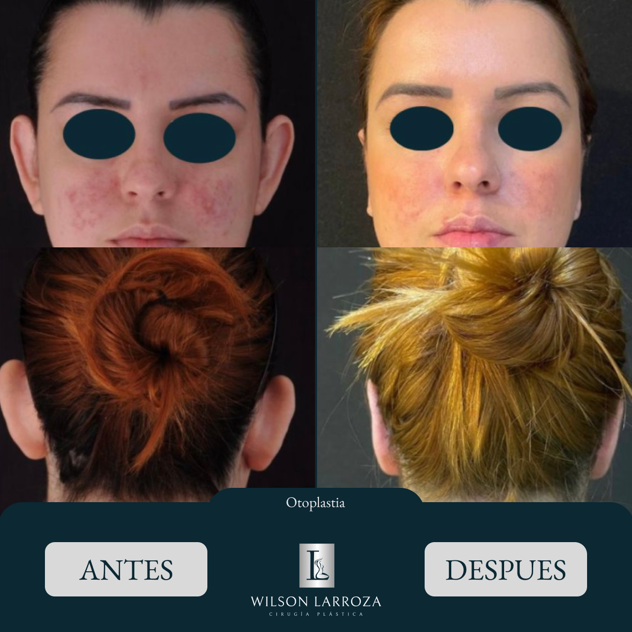 Rinoplastia en Asunción Paraguay
