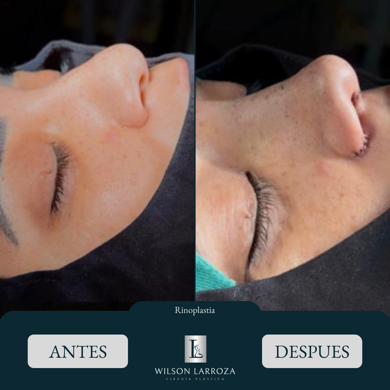 Resultado 4 | Cirujano Plástico en Paraguay Asunción