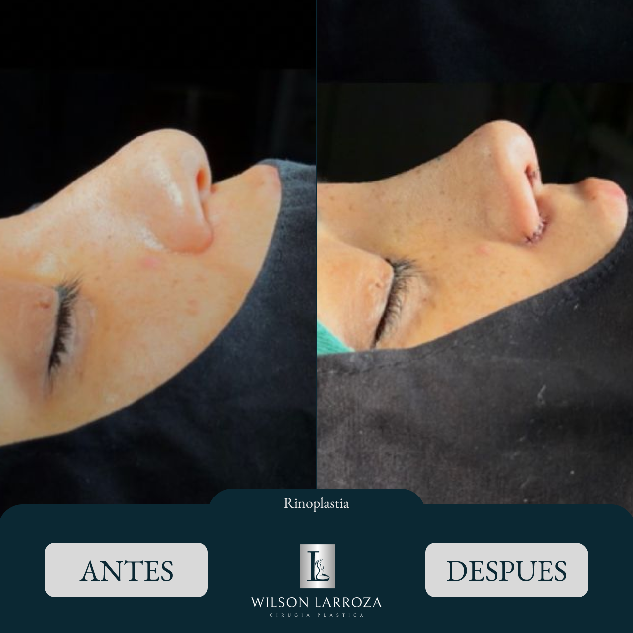 Resultado 4 | Cirujano Plástico en Paraguay Asunción